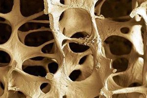 Physiotherapy for osteoporosis